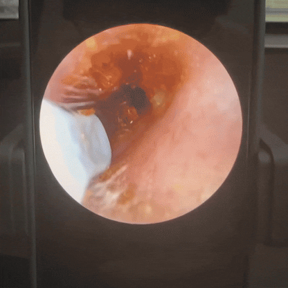 Slivor VisioEar: Doctor Approved Ear Health Technology